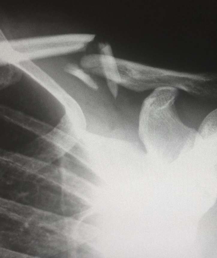 x-ray of broken bone