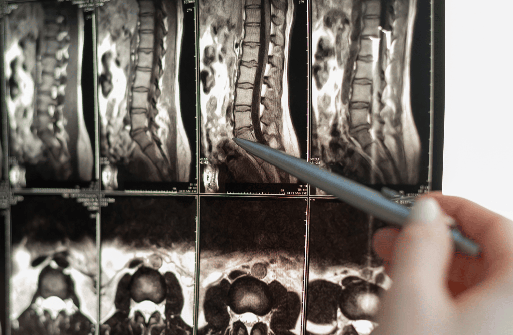 Photo of a doctor reviewing spinal cord X-rays